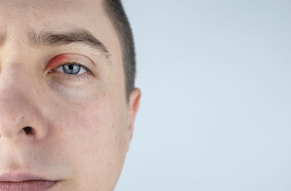 A young man with a red, swollen eyelid that could be caused by blepharitis.